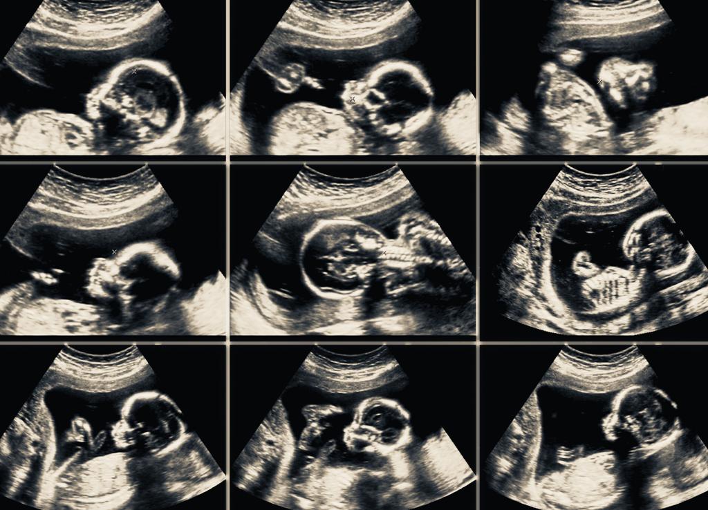 Collage of ultrasounds