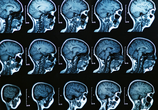 Multiple brain scans